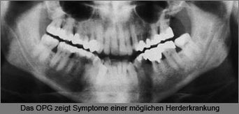 Wird grau zahn wurzelbehandelter Wurzelbehandlung: Wühlen